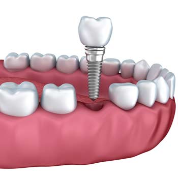 Dental-Implants-sub-pag